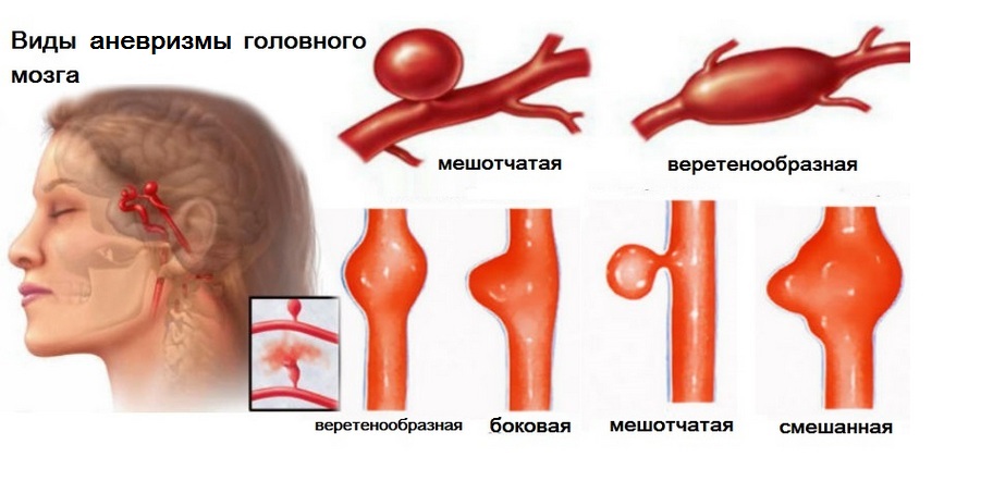 виды аневризмы