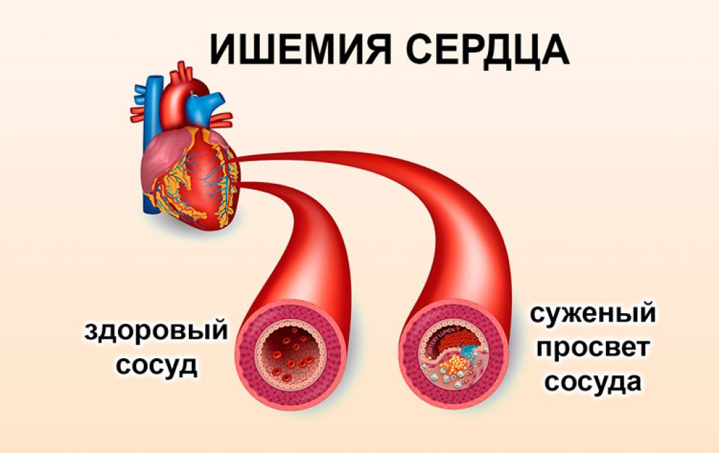Разновидности ИБС